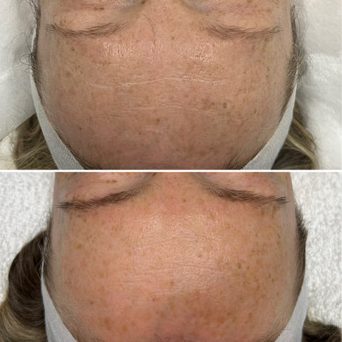 Corrective Peel Level 1