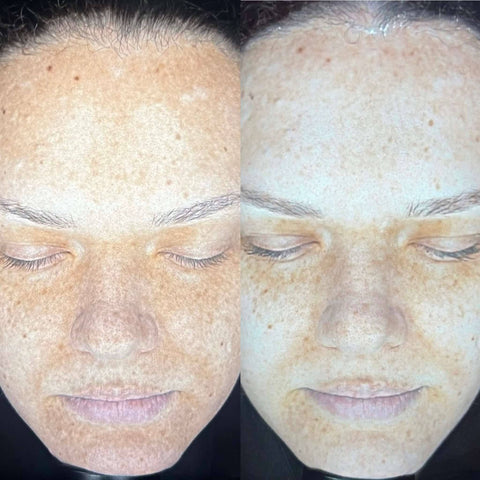 MelanoPro