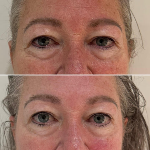Buccal Sculpting Facial