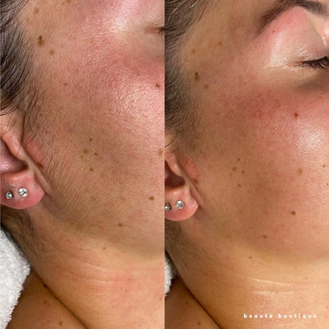 Dermaplaning Deluxe