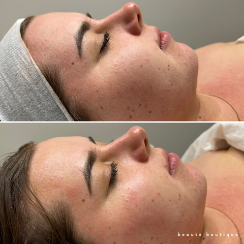 Dermaplaning Deluxe