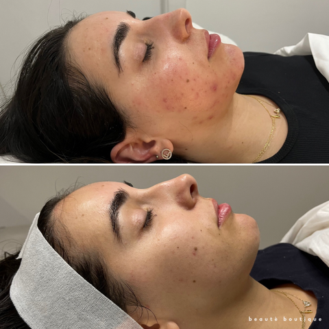 Corrective Peel Level 1