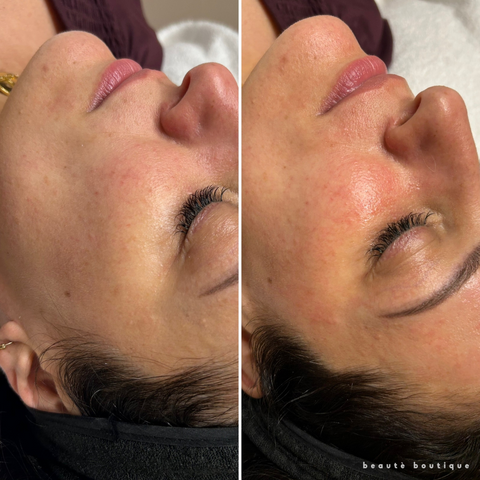 Dermaplaning Deluxe