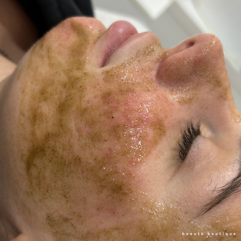 Corrective Peel Level 2