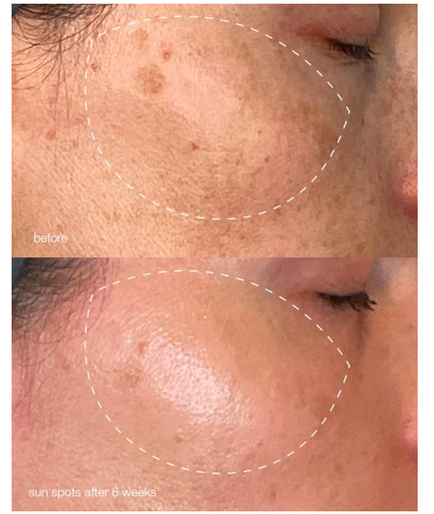 MelanoPro