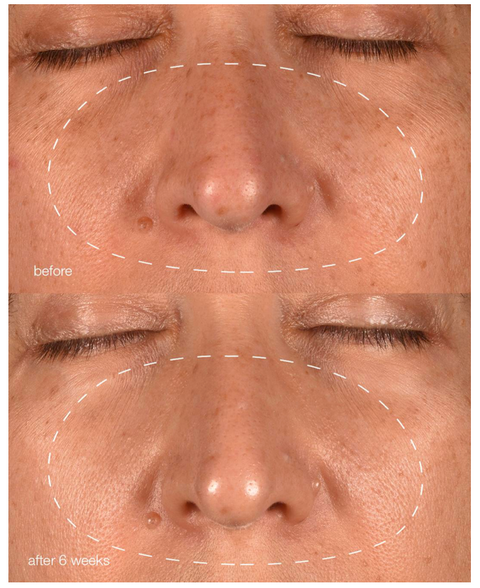 MelanoPro