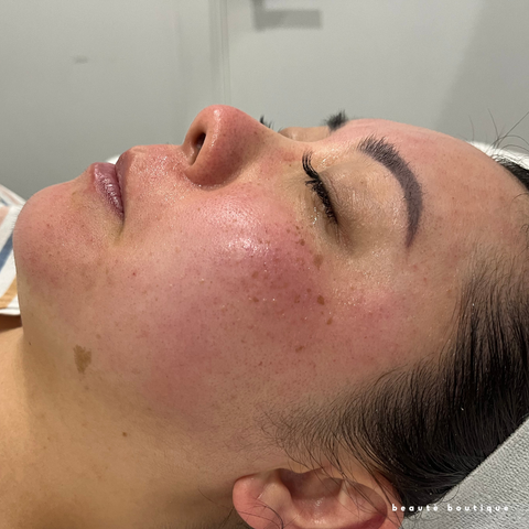 Skin Needling