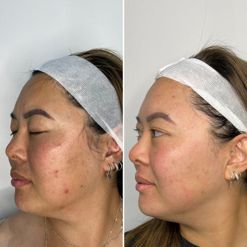 Corrective Peel Level 2