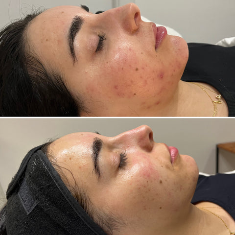 Chemical Peel Advanced