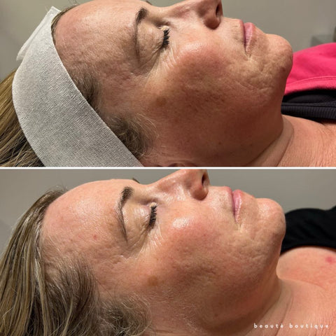 Chemical Peel Rebuild