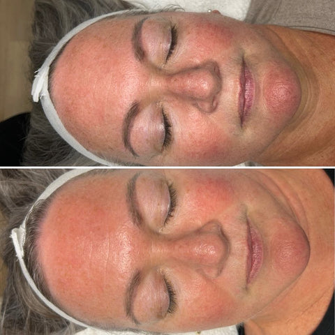 Chemical Peel Rebuild