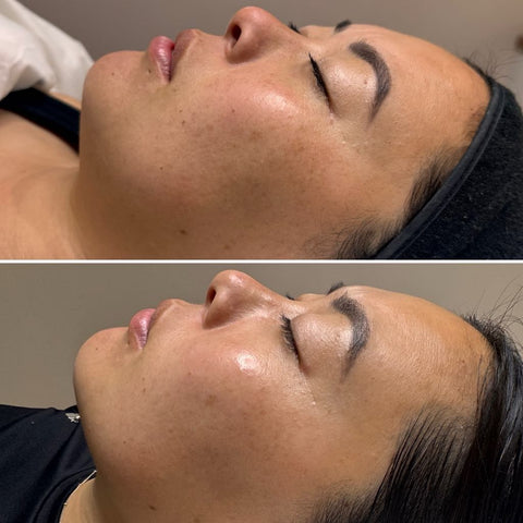 Skin Needling