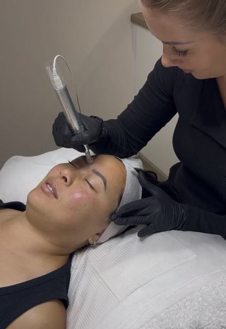 Skin Needling