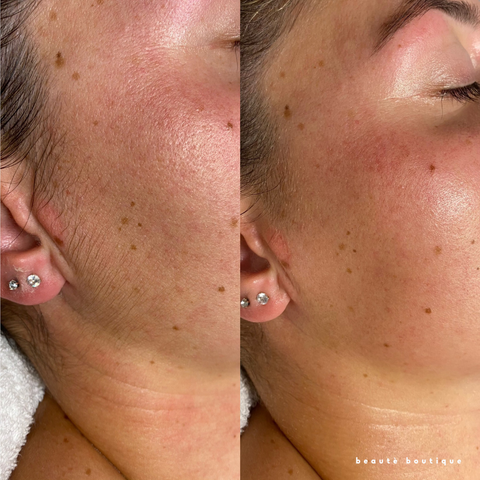 Nano Fusion + Dermaplaning