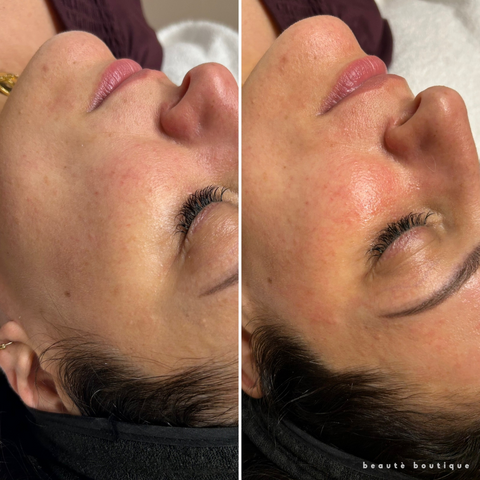 Nano Fusion + Dermaplaning