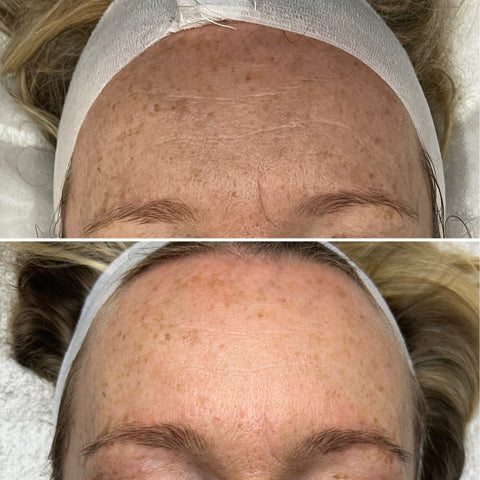 Chemical Peel Advanced