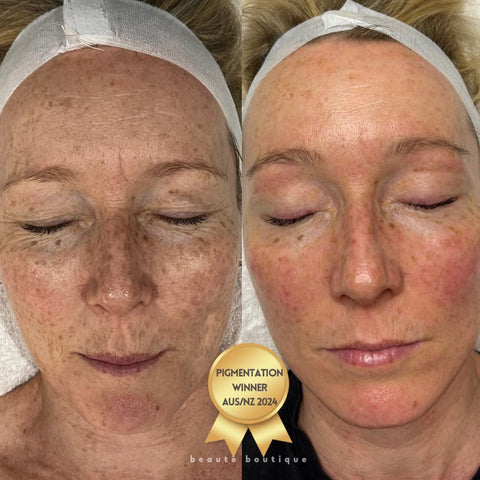 Chemical Peel Rebuild