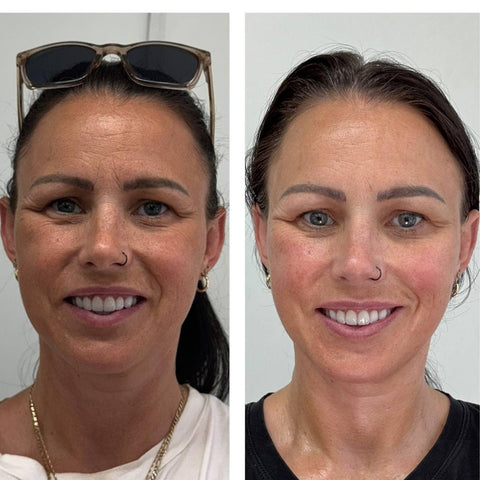 Buccal Sculpting Facial